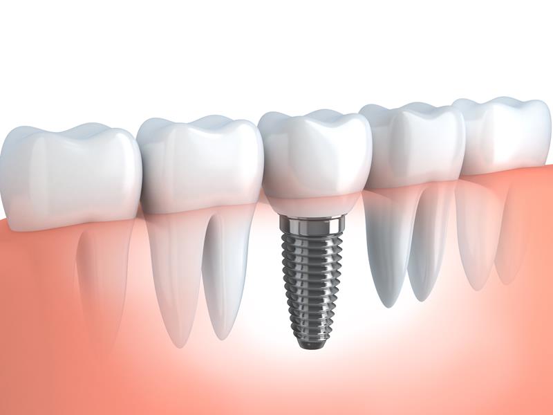 Dental Implants  Manhattan, MT 